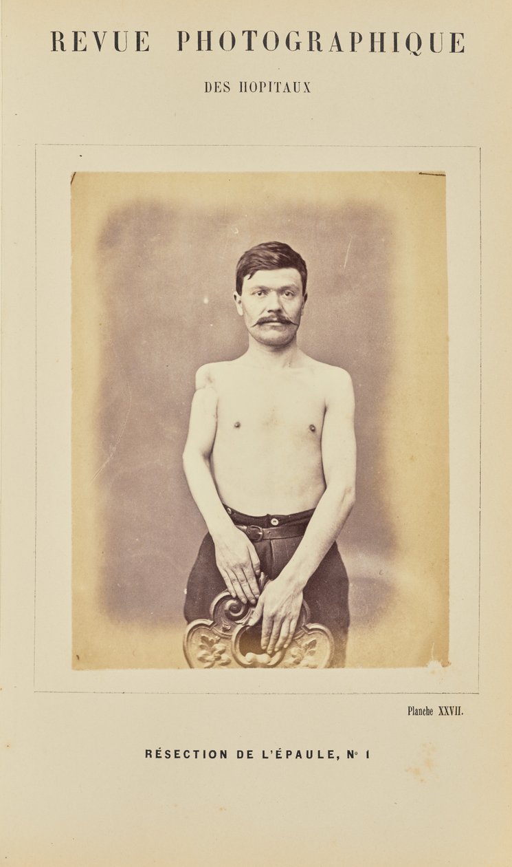 Resektion der Schulter, Nummer 1 von Arthur de Montmeja