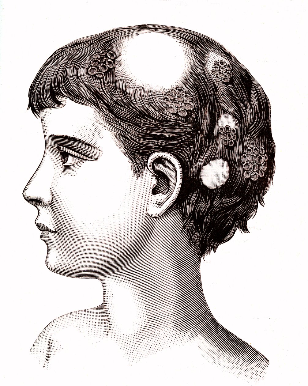 Ringelflechte bei einem Kind. 1887 (Gravur) von French School