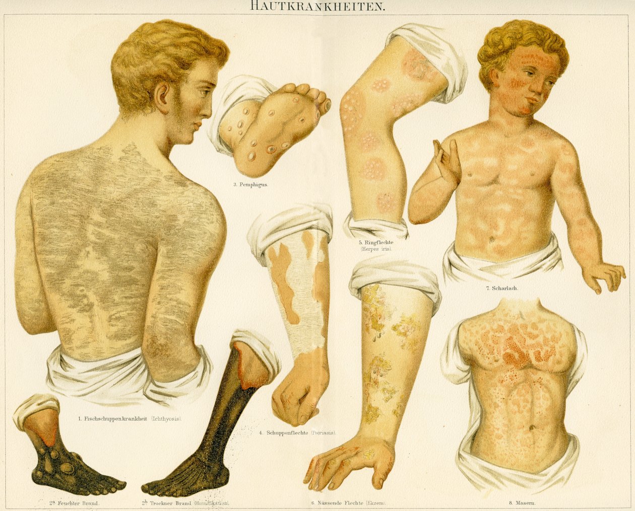 Hautkrankheiten, ca. 1890 von German School