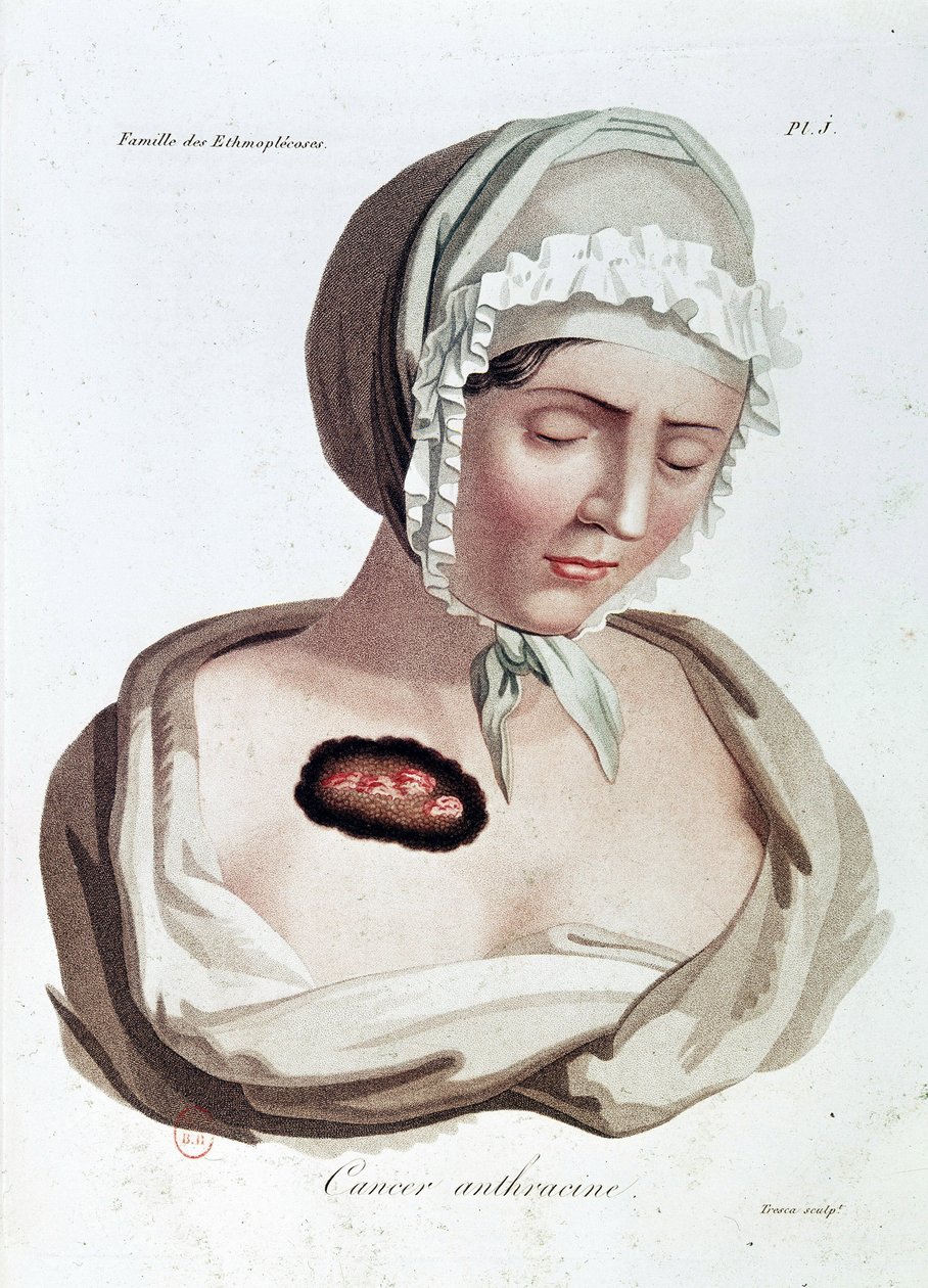 Anthrazin-Krebs - Alibert, B.N. von Jean Louis Alibert