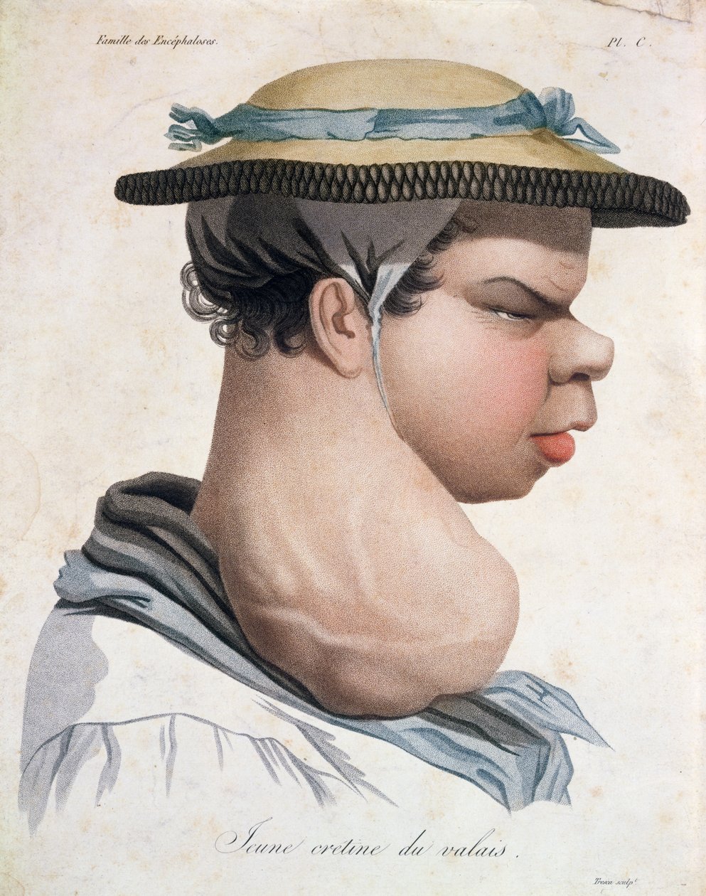 Junger Kretin aus dem Wallis, Illustration aus einem Buch von Baron Jean Louis Alibert von Salvadore Tresca