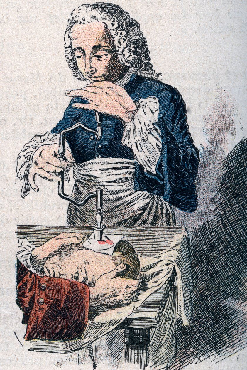 Die Trepanation. Druck des 18. Jahrhunderts. von Unknown artist