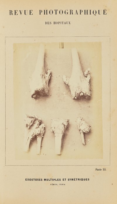 Mehrfache und symmetrische Exostosen, Femur, Tibia von Arthur de Montmeja