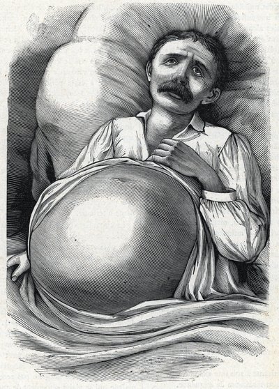 Patient mit fortgeschrittener Leberzirrhose (Gravur) 1888 von French School