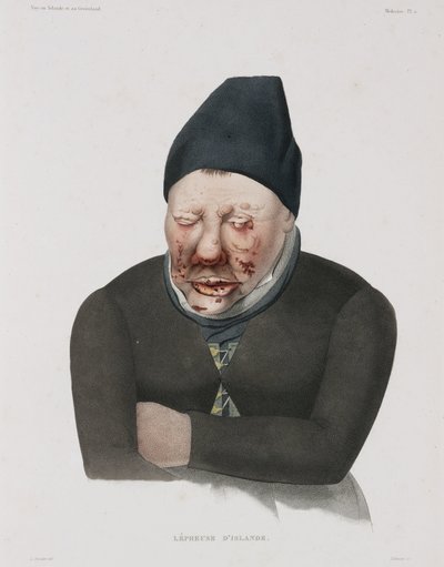 Krankheiten, Lepra von Unbekannt