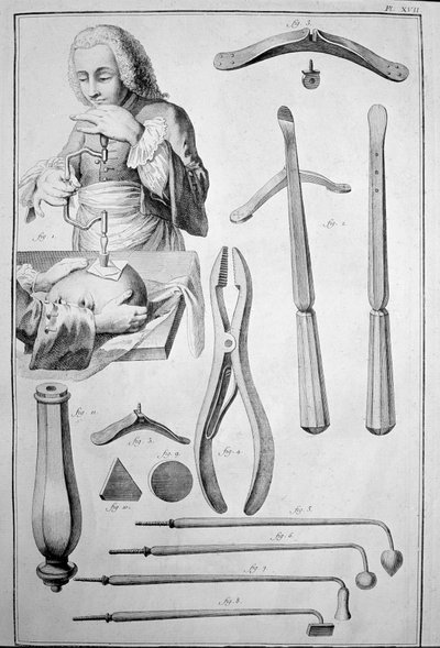 Trepanation des Schädels, verschiedene Instrumente (Gravur) von Unknown artist